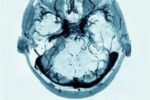 Examination Prints: Cerebral venous thrombosis of the left transverse sinus. Radial section brain CTA scan