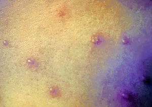 Prevention Prints: A close-up of a maculopapular rash