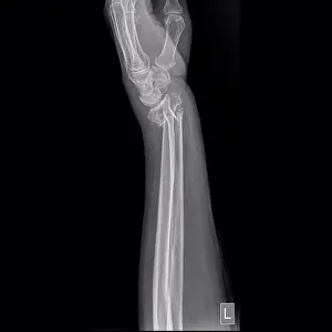 Lower Prints: Colles fracture, X-ray