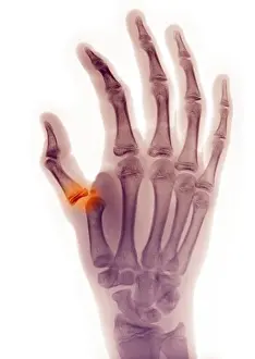 Injured Prints: Colorized x-ray of the hand of a 16 year old boy who dislocated his thumb at the metacarpal phalangeal joint