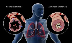 Upper Body Prints: Comparison of a normal bronchiole and an asthmatic bronchiole in the human respiratory tract