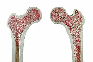 Neck Prints: Cross sections through models of a normal (left) and and fractured femur (right) thigh bone