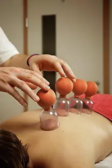 System Prints: Cupping, cupping glasses, patient getting a cupping treatment