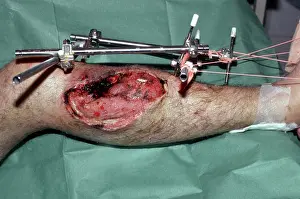 Works Prints: External metal fixation of a lower leg fracture
