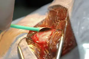Cleaning Prints: Eyeball is wiped with cotton bud to clean it