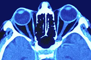 Examination Prints: Two eyes and their optic nerves, seen on a radial section scan