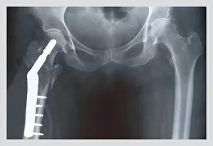 Anatomy Prints: Femur Repair, Medical - Xray / Radiology