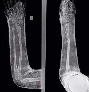 Disorder Prints: Fractured hand in cast, X-ray