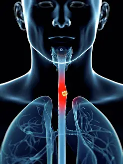 Anatomy Prints: Human food pipe (oesophagus) with tumour, computer artwork.