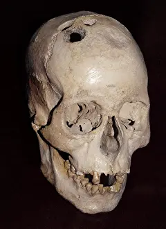 Medical Prints: Human skull with evidence of trepanning