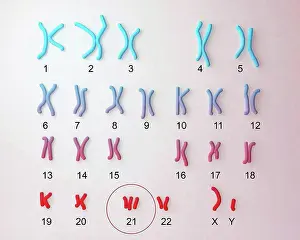Disorder Prints: Karyotype showing the arrangement of chromosomes in a female with Down's syndrome (trisomy-21)