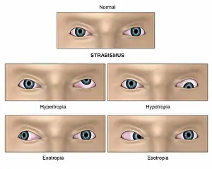 Chart Prints: Medical illustration showing strabismus
