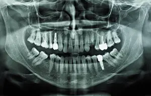 Tooth Prints: orthopantomograph panoramic image radiograph of teeth orthopantomogram single panoramic image radiograph of
