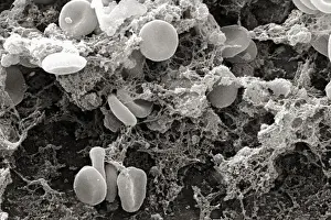 Scanning Electron Micrograph Prints: Red Blood Cells Enmeshed in Fibrinous Matrix
