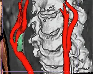Radiology Prints: Stenosis of carotid artery