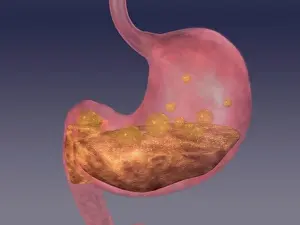 Sseditor Aa Prints: Stomach