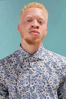 Disorder Prints: Studio portrait of albino man in blue patterned shirt