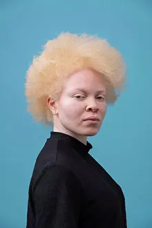 Disorder Prints: Studio portrait of albino woman
