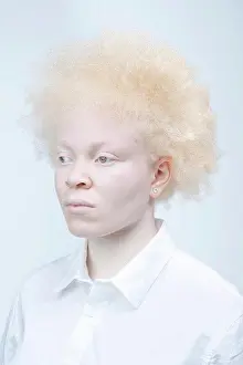 Diverse Prints: Studio portrait of albino woman in white shirt