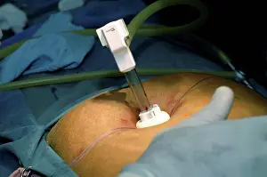Sudan Prints: Surgeon performing Cholecystectomy (gall bladder removal)