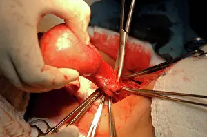 Surgery Prints: Surgeons removing goitre from patient