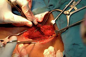 Surgery Prints: Surgeons removing goitre from patient. Close-up