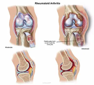 Disorder Prints: Front view and cross section of knee showing moderate and advancd rheumatoid arthritis