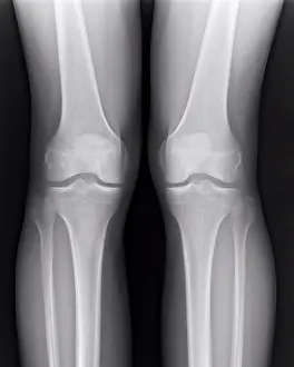 Body Parts Prints: An x-ray of human legs and knees