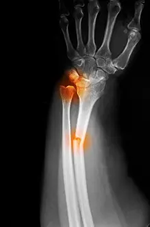 Injured Prints: X-ray of a radius forearm fracture of a 52 year old woman with an associated wrist dislocation