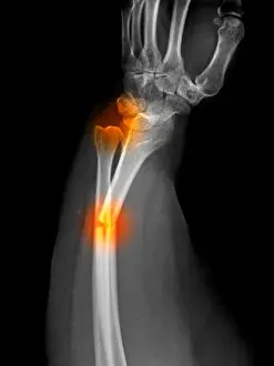 Injured Prints: X-ray of a radius forearm fracture of a 52 year old woman with an associated wrist dislocation