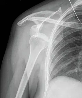 Disorder Prints: X-ray showing a dislocated shoulder