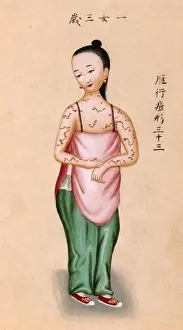 Diseases Prints: Young Chinese girl with smallpox, illustration from Notes on Diverse Eruptions, 1786